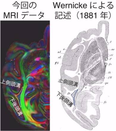 サルとヒト、視覚情報を伝える脳の線維束が類似