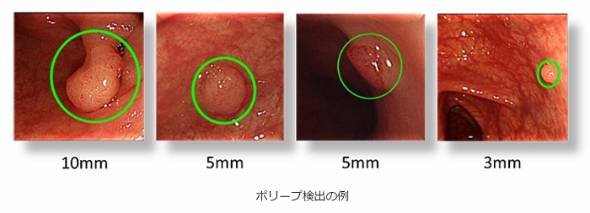人工知能を用いた「大腸がん」発見システム