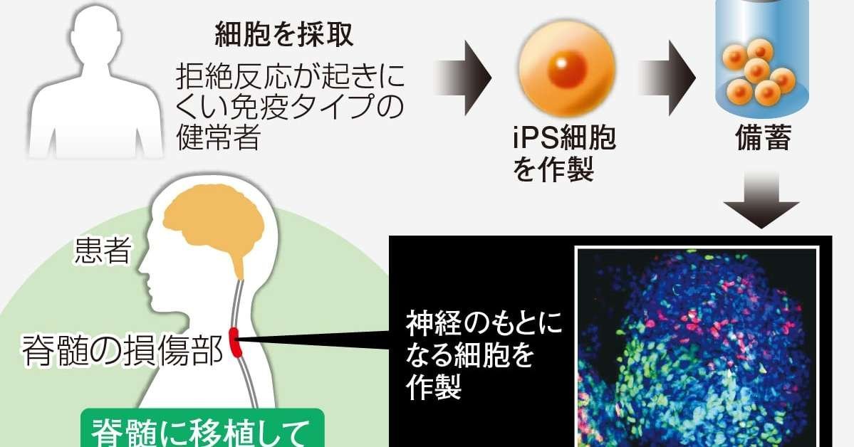 慶大のiPS脊髄損傷治療、最長4年追跡で長期的な安全性確認 来年度中に